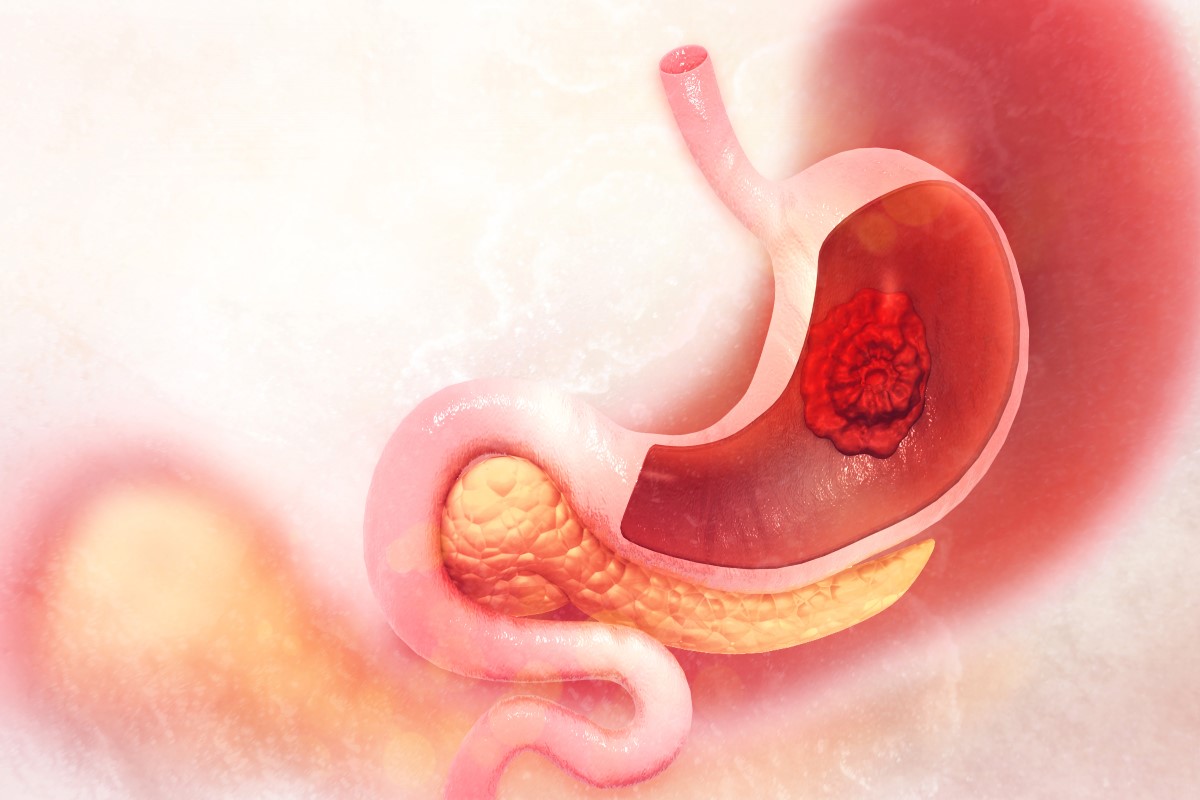 Visualization of a malignant tumor localized in the stomach.