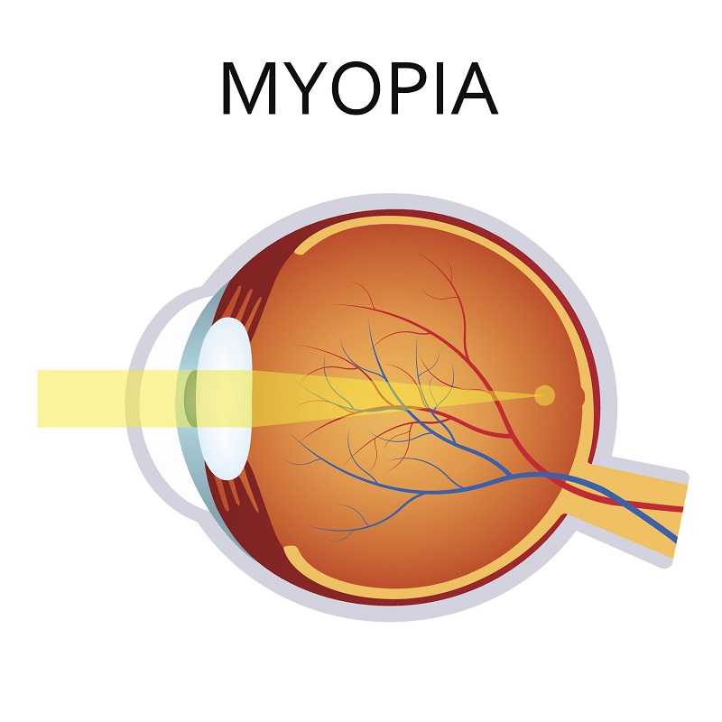 Myopia - a model of the eye and the convergence of rays of light in front of the retina