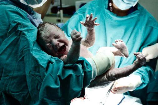 a crying newborn in the hands of a doctor just after the section