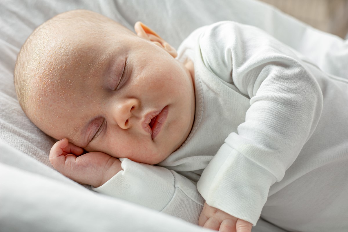 A small child, newborn, sleeping, with seborrhea and scales on his head.