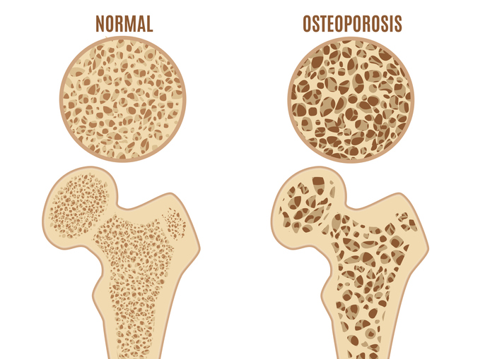 Osteoporosis of the femur