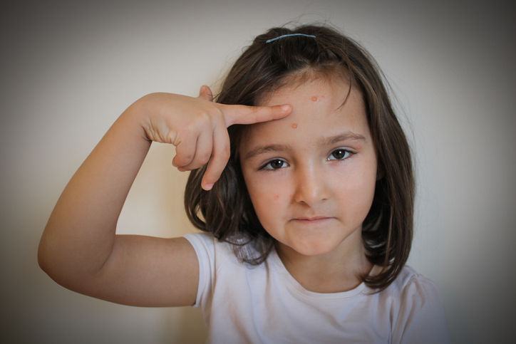 Varicella zoster virus - a girl with a rash on her face