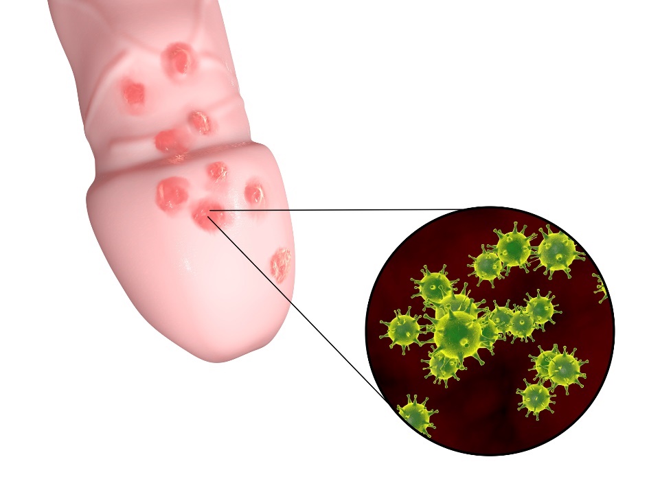 The formation of small genital herpes blisters in the genital area of the male organ.