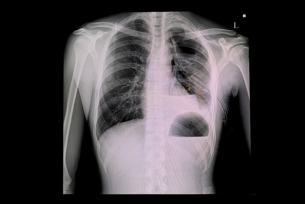 X-ray of pneumothorax of the left lung and air accumulation in the pleural cavity of the chest (white colour)