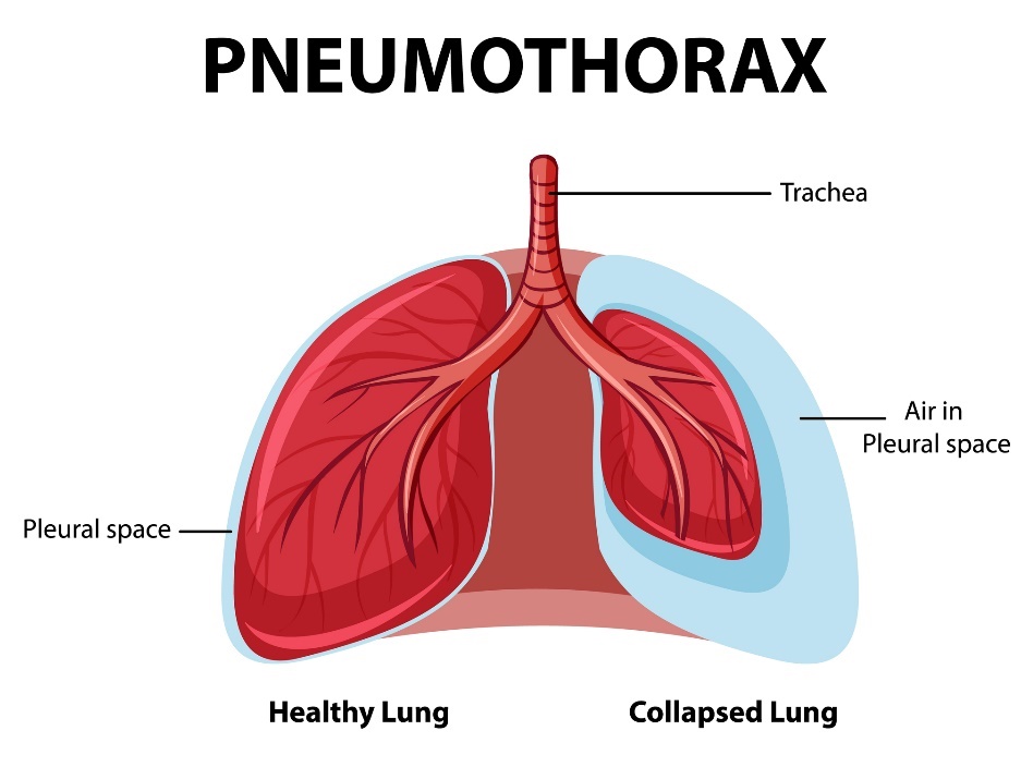 Pneumothorax: healthy and collapsing lungs