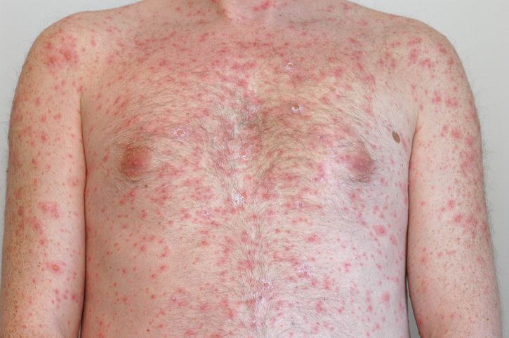 Chickenpox rash all over the body of an adult