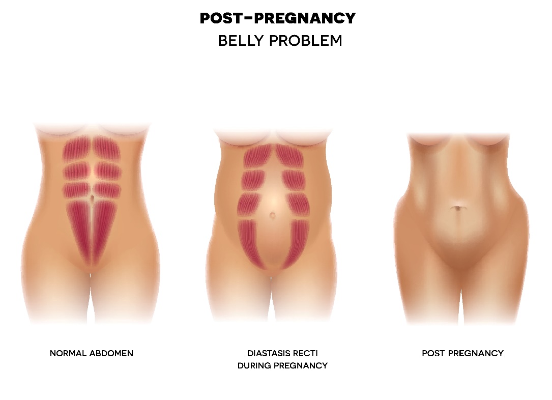 Postpartum diastasis of the abdominal wall
