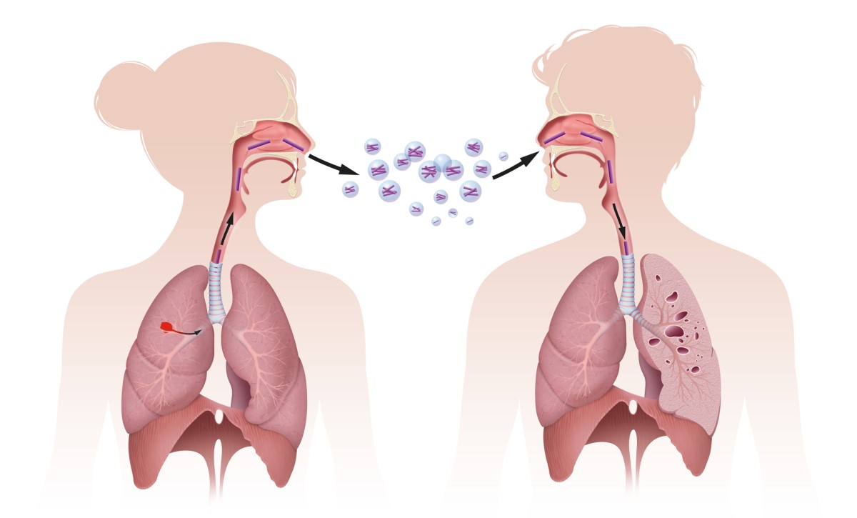 Transmission of TB by inhalation, i.e. by inhalation, the figure shows transmission by inhalation.