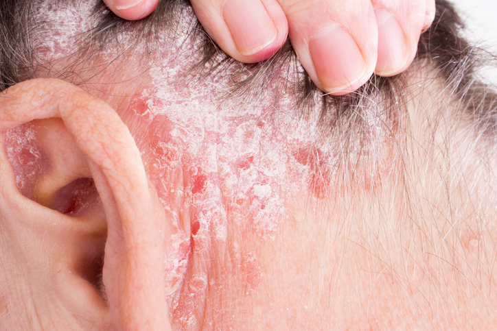 Psoriasis of the head, behind the ear and in the hairy part of the head