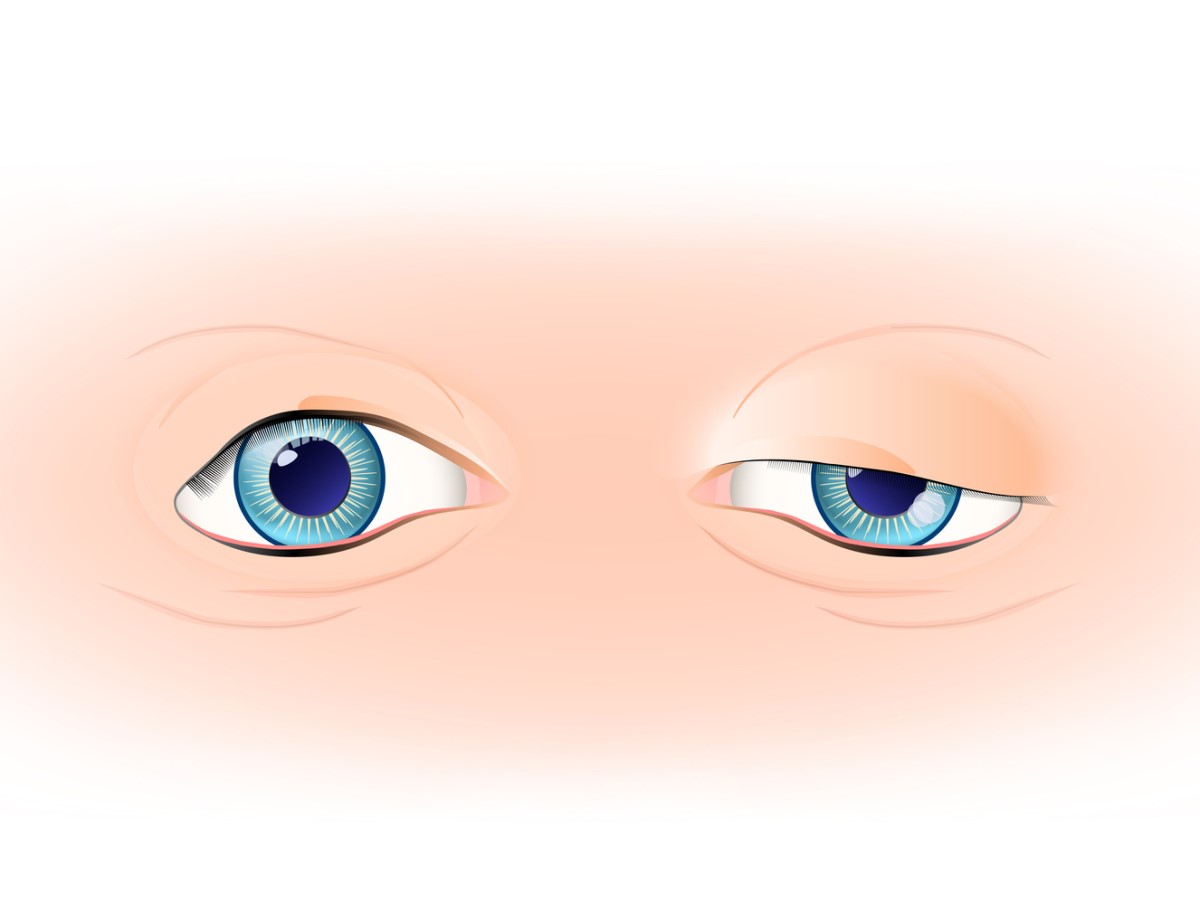 Eyelid ptosis, left eyelid in normal condition and right eyelid with droop - ptosis