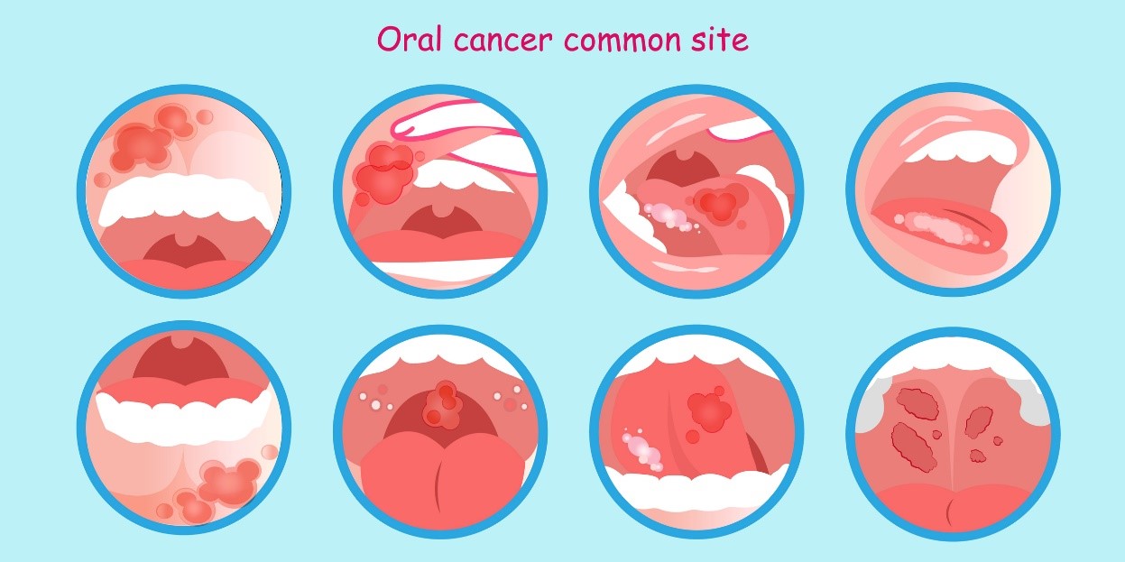 Oral cancer and tumour deposits - a model