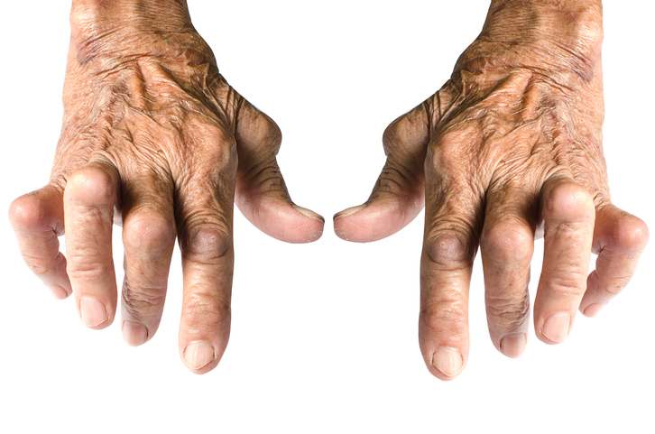 Typical hand deformities in rheumatoid arthritis