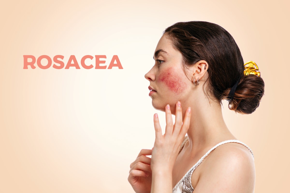 Woman from the side, face with rosacea - rosacea