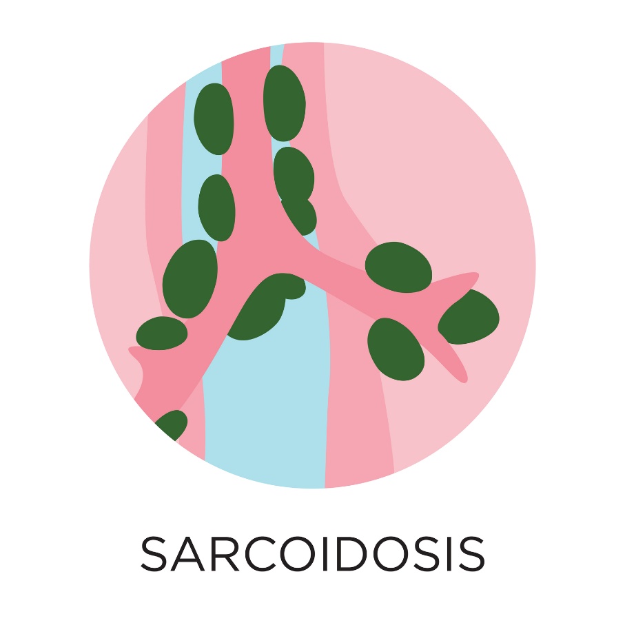 Sarcoidosis - formation of granulomas