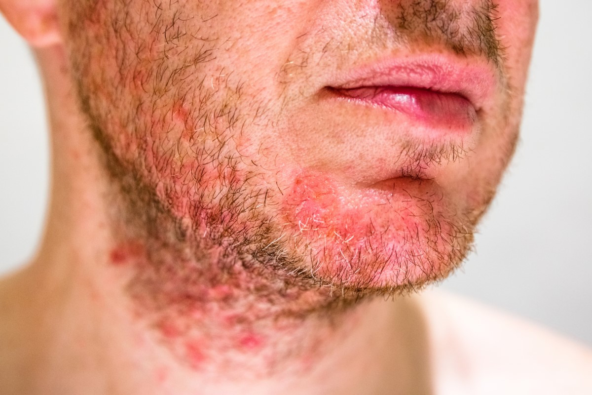 Man with seborrhoea on chin, red face with signs of dermatitis