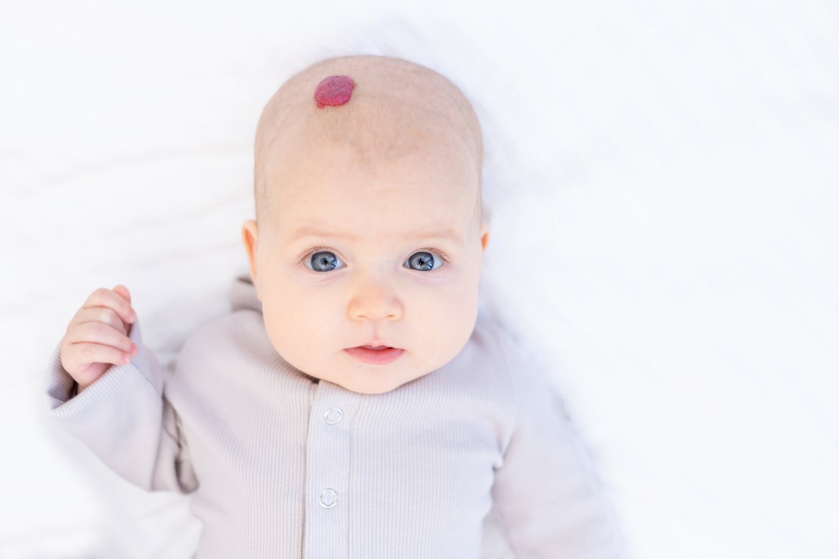 Hemangioma on the head of a child - a common occurrence