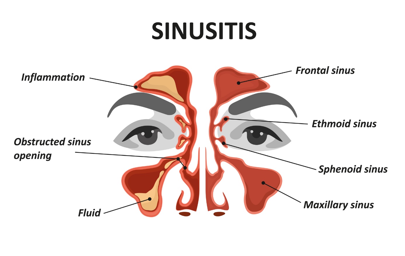Animated model/image of sinusitis and sinusitis