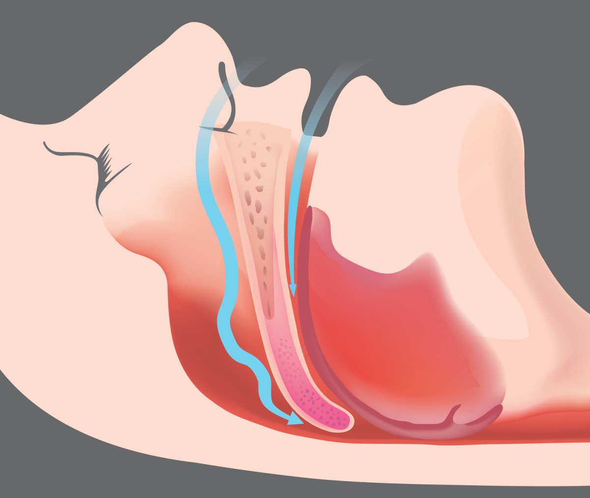 Obstructive apnoea and airway obstruction - animated picture and airway model