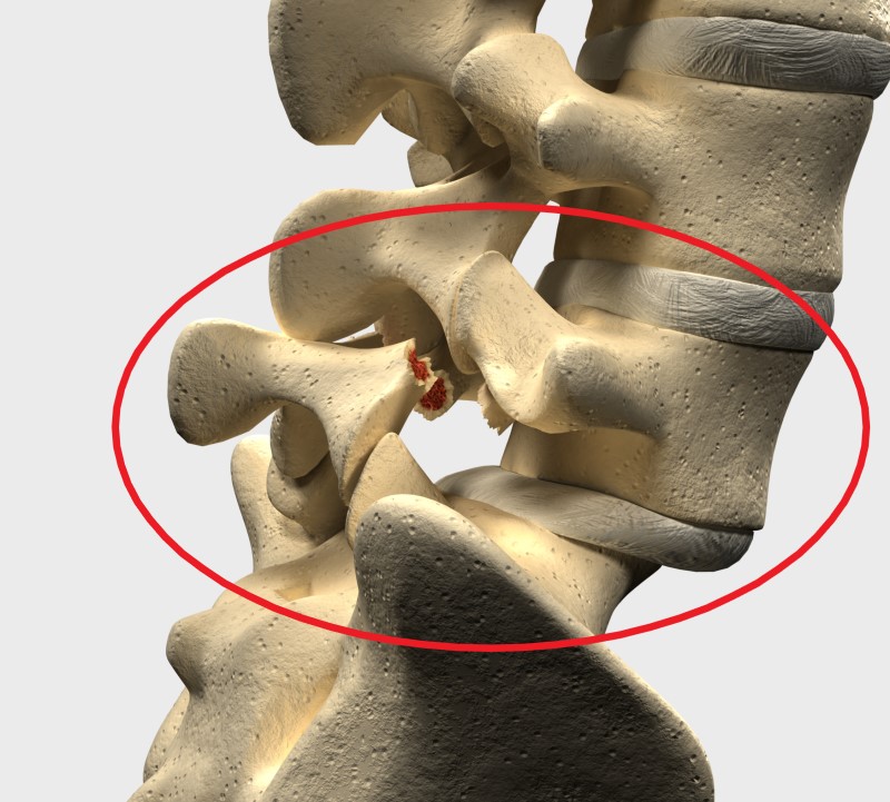 Spondylolisthesis in the lumbar region L5 and S1 - spine model