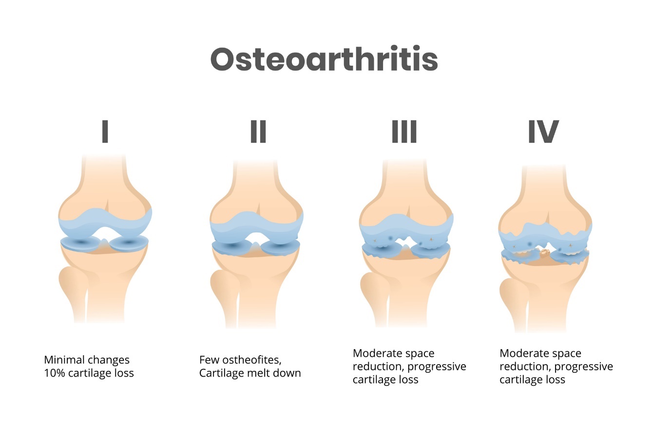 4 stages of arthrosis