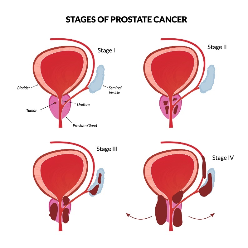 4 basic stages of prostate cancer