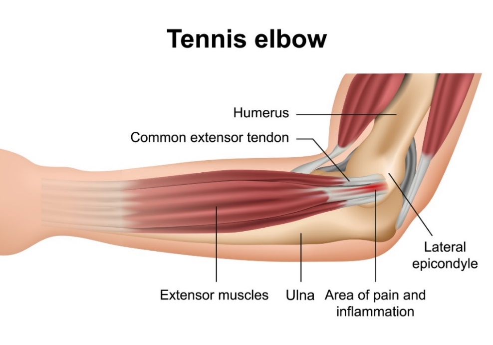 Tennis elbow (lateral epicondylitis): the bones of the elbow joint, the extensors of the muscles of the forearm, the lateral epicondyle and the site of primary pain.