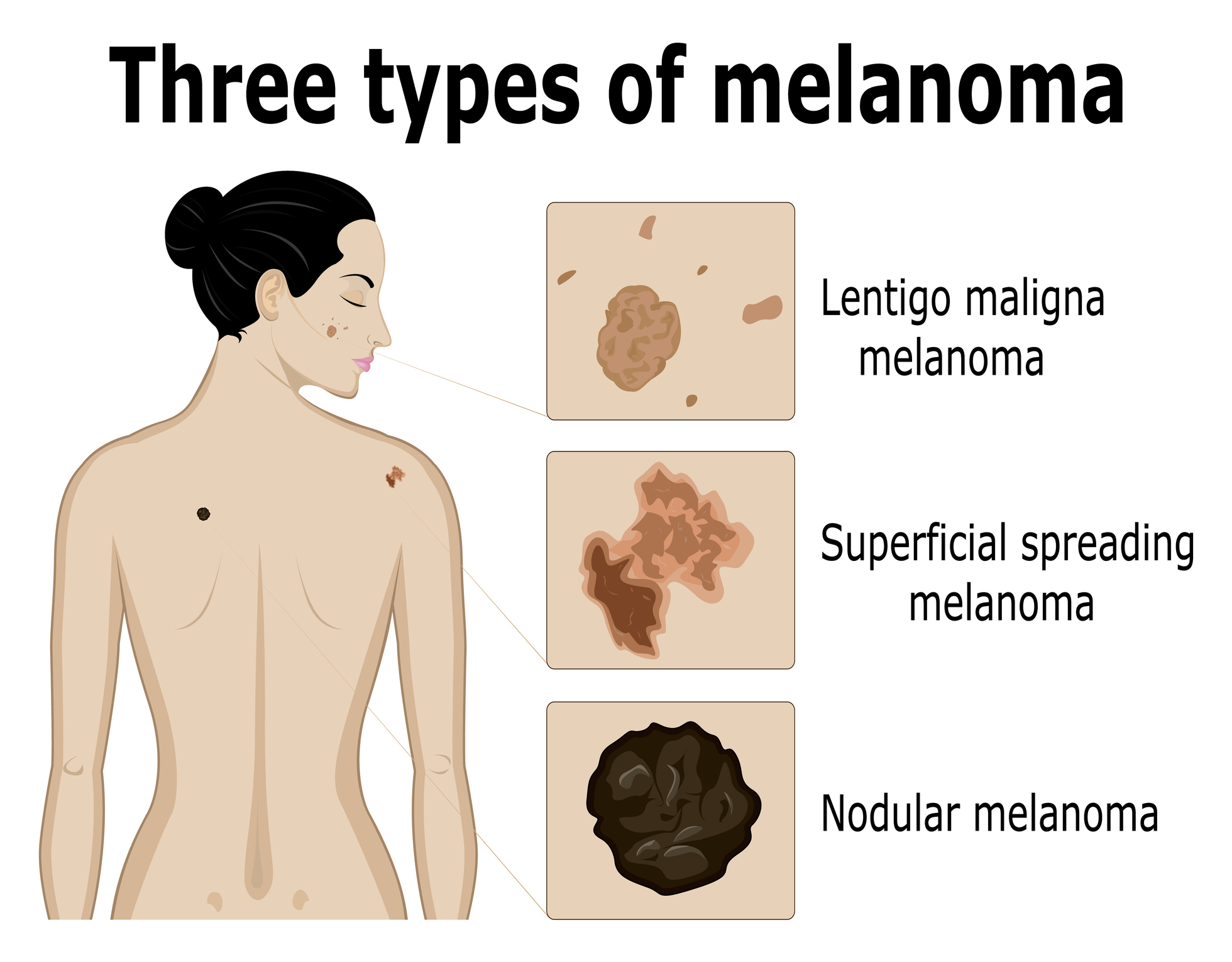 Imaging of the three types of melanoma