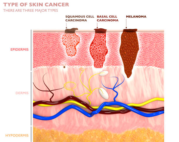 Types of skin tumours, their penetration into the skin - squamous cell carcinoma, basalioma and melanoma
