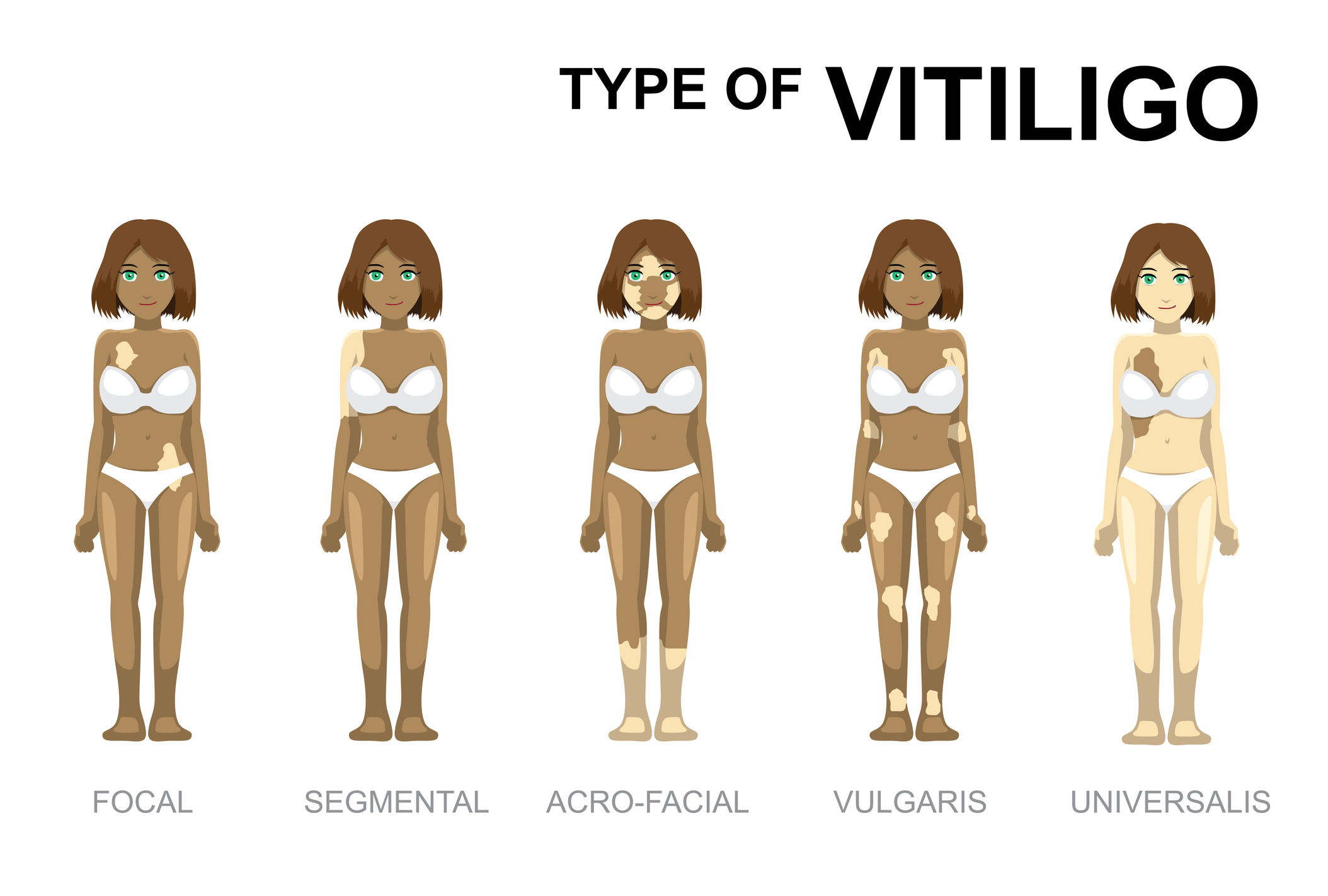 Types of vitiligo
