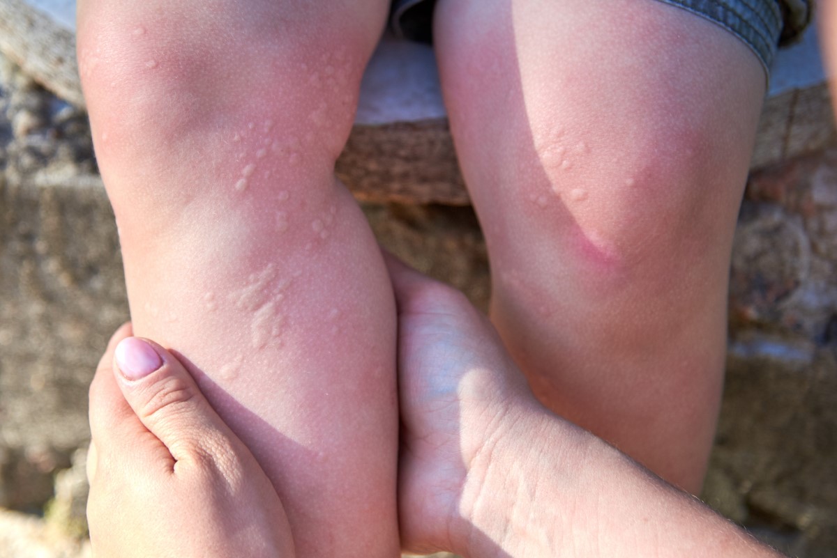 Urticaria in a child on the lower extremities.