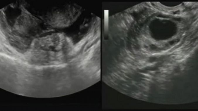 USG - sonography of the abdomen - image during examination, imaging of the uterus and ectopic pregnancy
