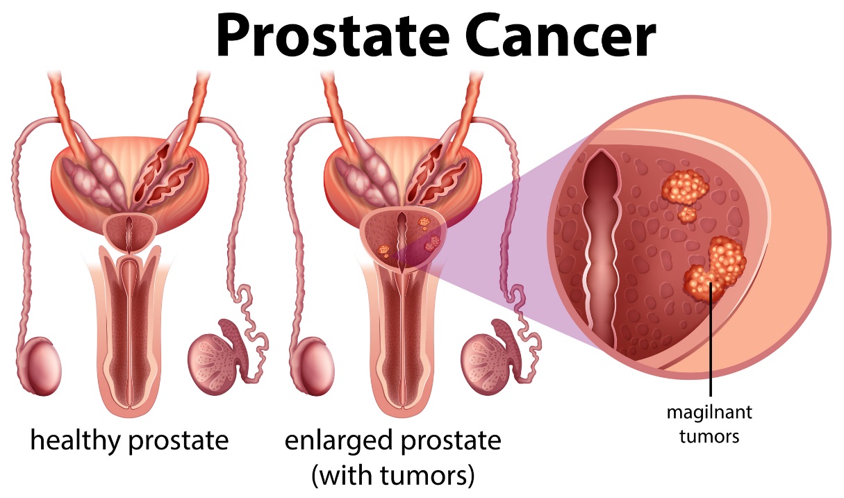 Prostate cancer. Healthy prostate and enlarged prostate with tumor.