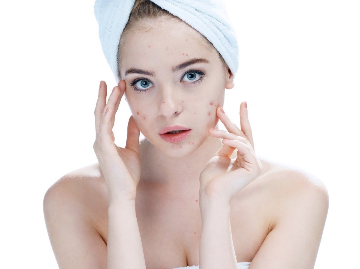 Acne on a woman's face, hair in a towel.