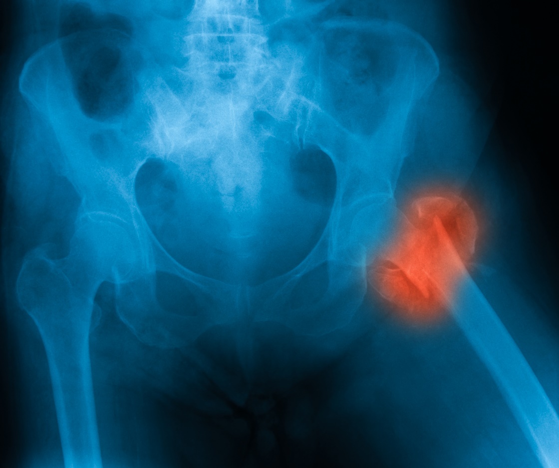 Fracture of the femoral neck