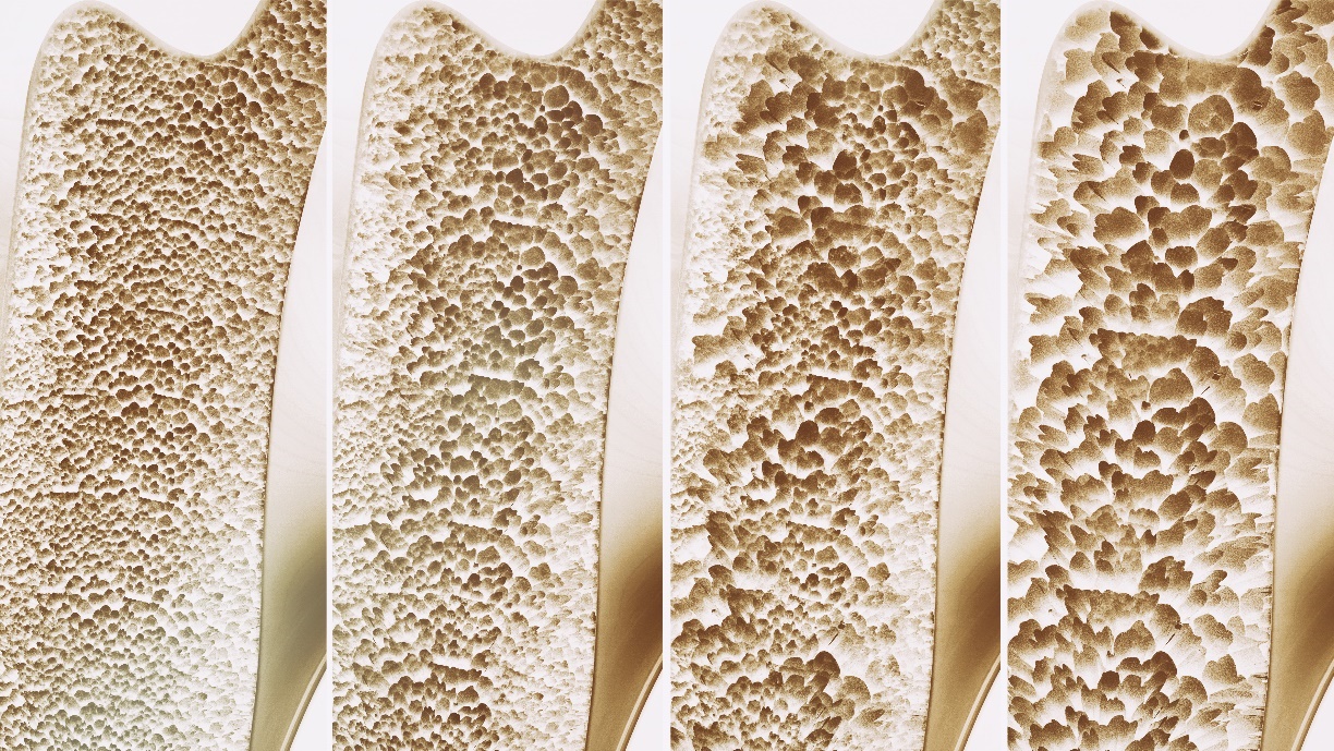 Change in bone density in cross-section