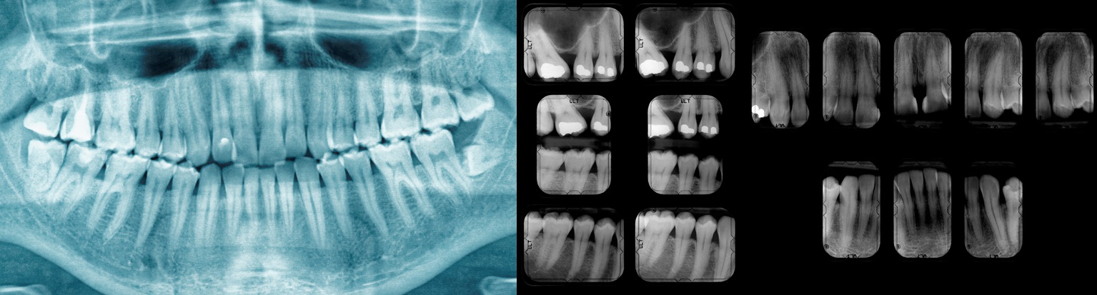 Dental X-ray, which will show the condition of the teeth, tooth decay and fillings