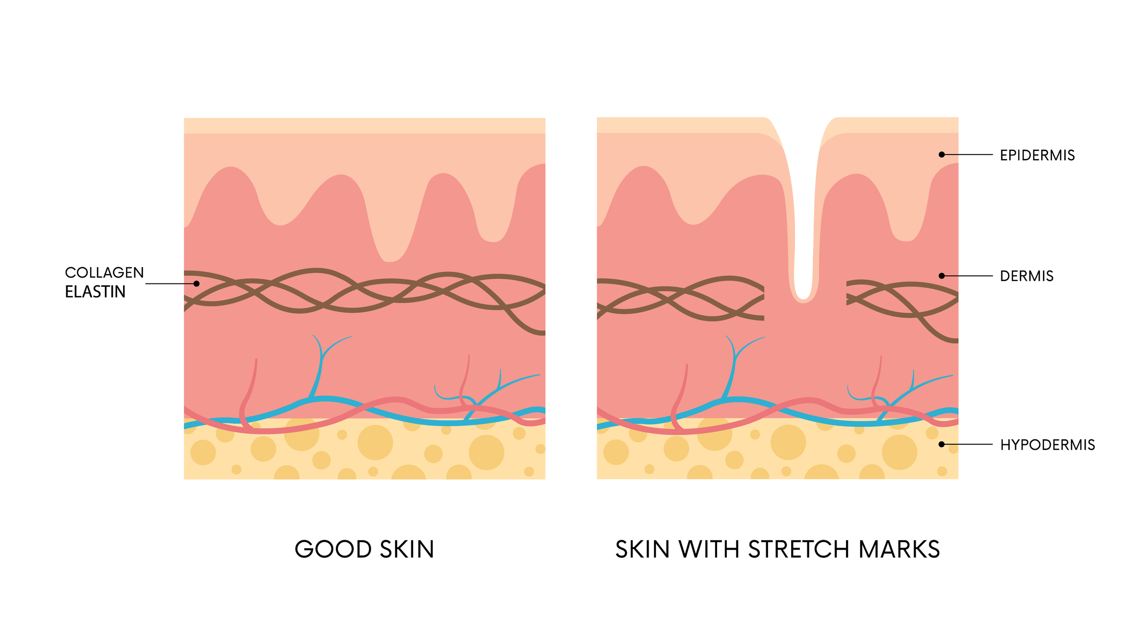Animated model: comparison of healthy skin and skin damaged by stretch marks