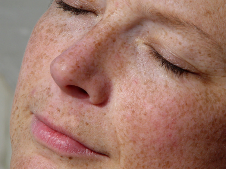 a satisfied female face with pigment spots and closed eyes