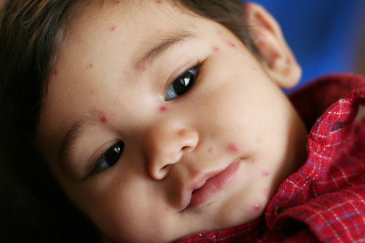 little boy in red shirt with chicken pox