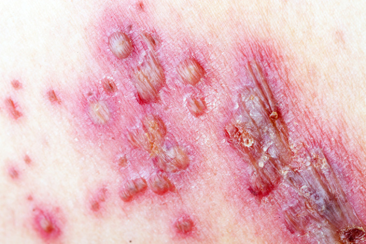 part of the skin with herpetic seeding in the form of blisters