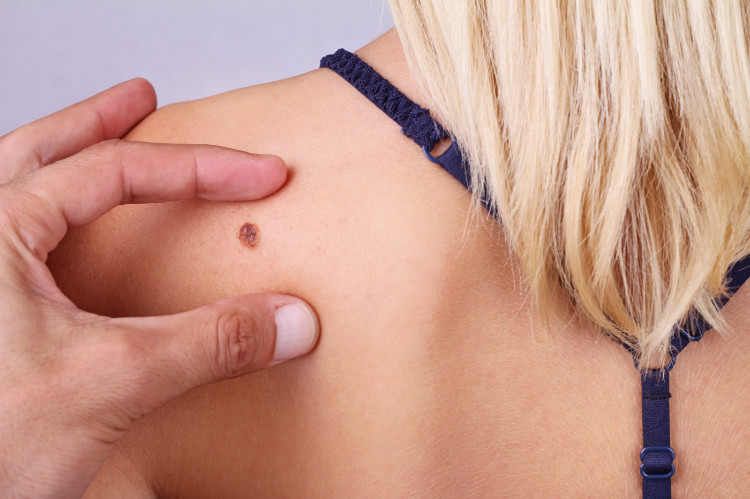 a doctor's hand points to a mole on a woman's back
