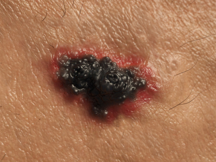 skin cancer, malignant black melanoma with red edges