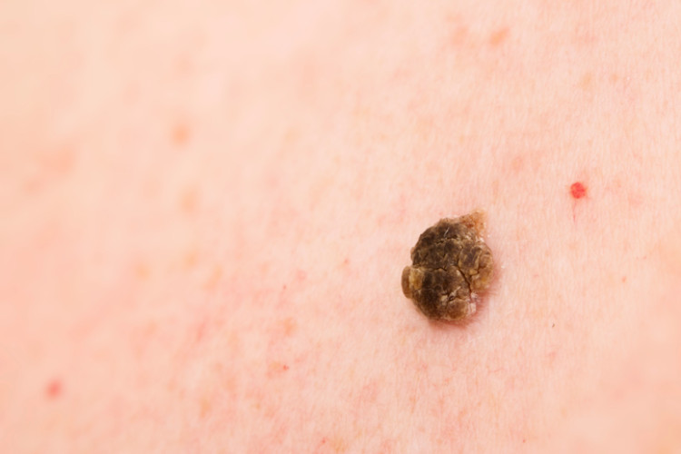 brown warts on the skin of the back