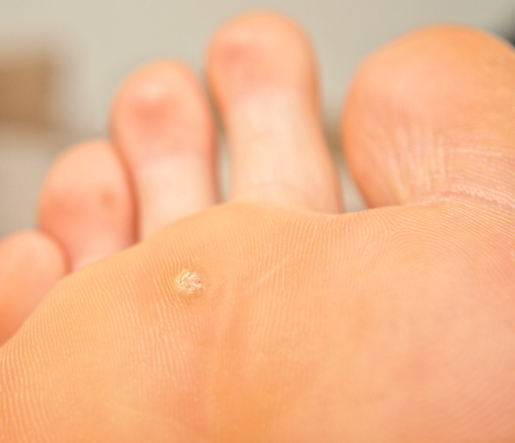 warts of skin colour on the foot