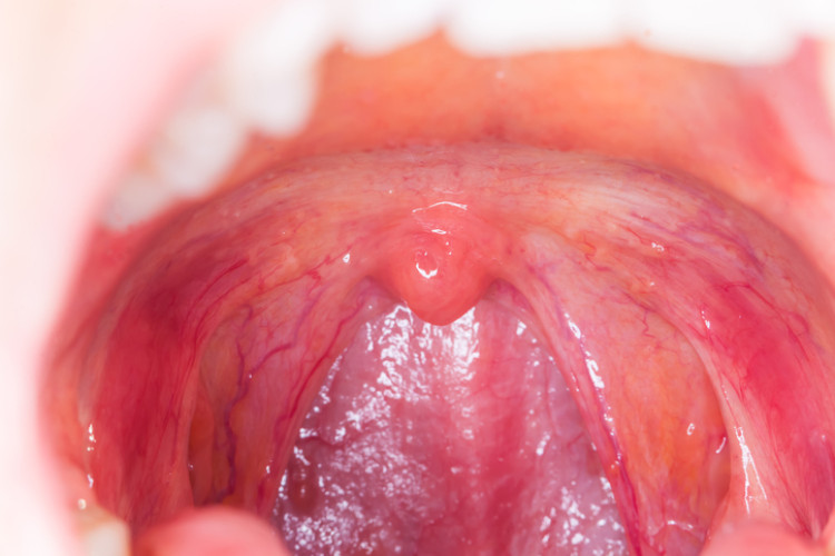 open mouth with inflamed tonsils