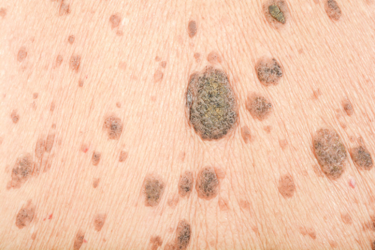 brown age warts on the skin of the back