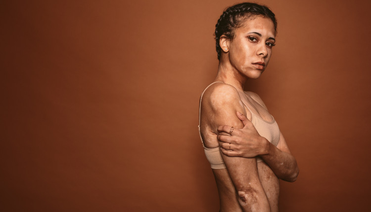 woman with white spots on her body - vitiligo