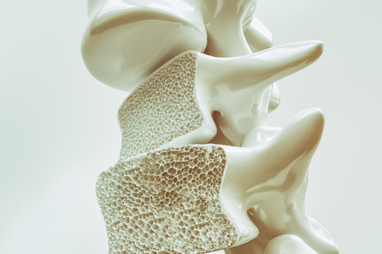 vertebral bone with reduced bone density