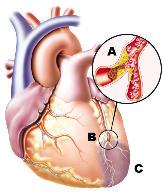 anatomical drawing of the heart with a blocked blood vessel