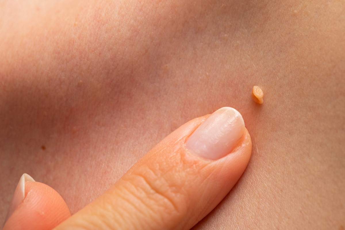 HPV warts on the skin of a woman